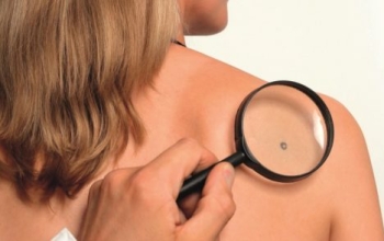 “Clicca il neo” l’App tutta italiana per battere il melanoma