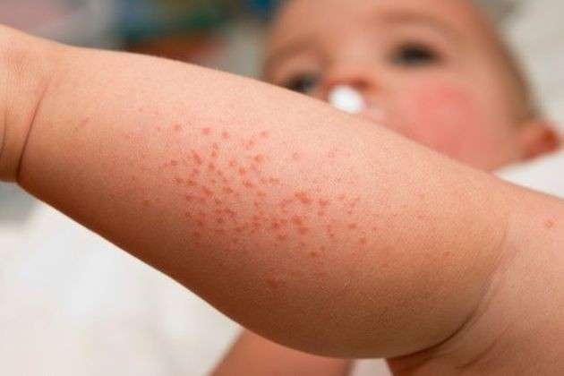 Nella foto il braccio di un bimbo colpito da dermatite atopica
