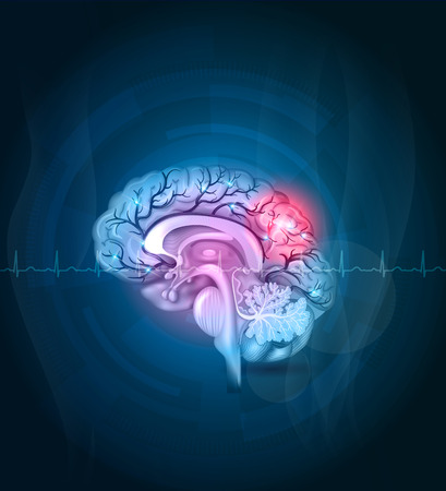 L'immagine di un cervello colpito da stroke