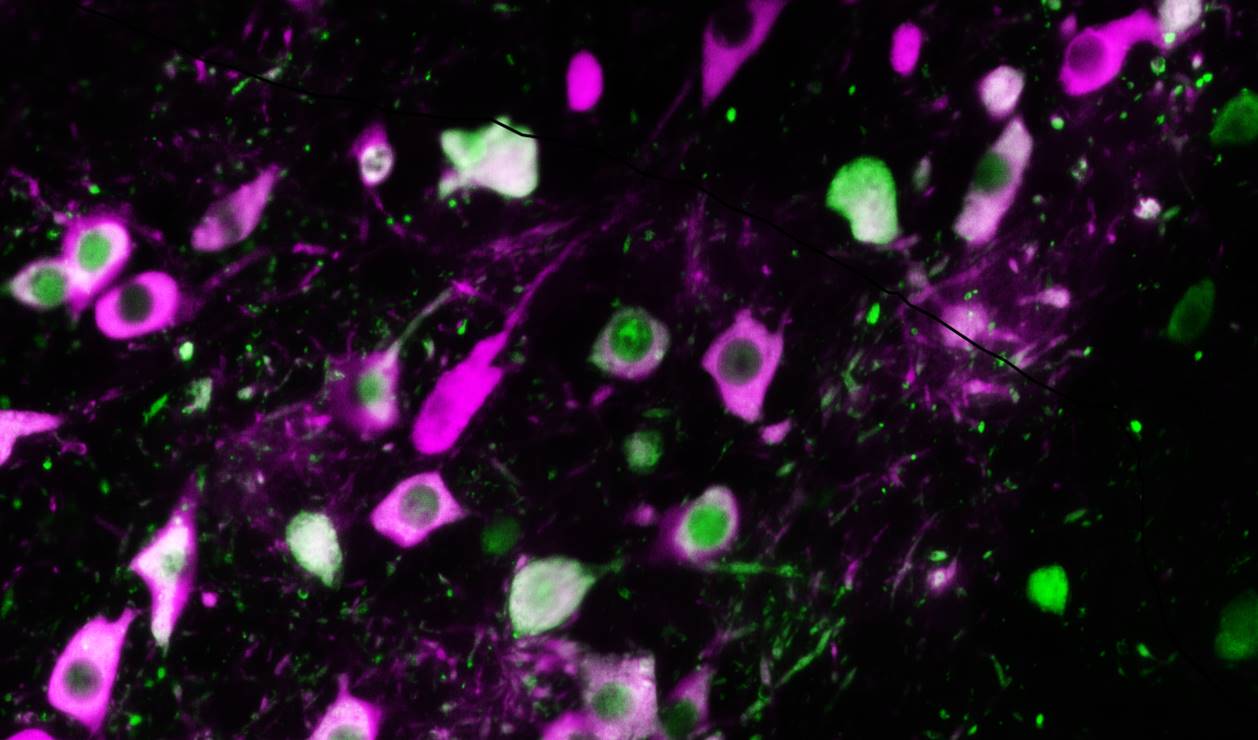 Parkinson, l’alfa-sinucleina (verde) colonizza il corpo cellulare dei neuroni che producono dopamina (rosa) e ne distrugge le funzioni normali