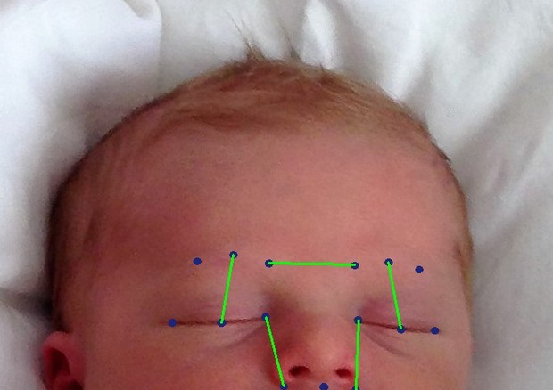 dolore, un app riconosce la mimica facciale nei bambini