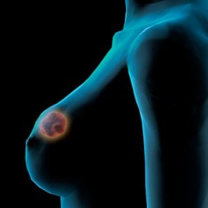 Alla mammella il tumore più diffuso. In Emilia e Toscana si sopravvive di più