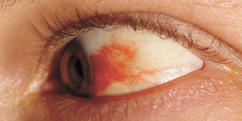 Diabete, occhio con retinopatia diabetica