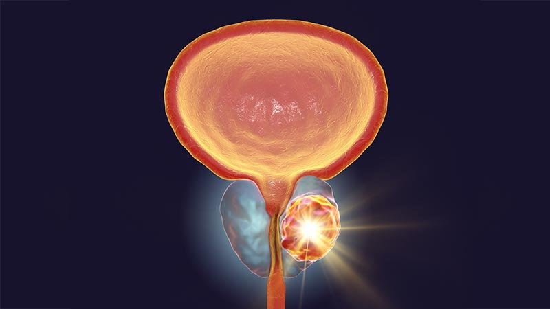 Conceptual image for prostate cancer treatment