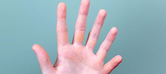 Malattie rare: la mano di un bimbo