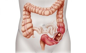 tumore colon