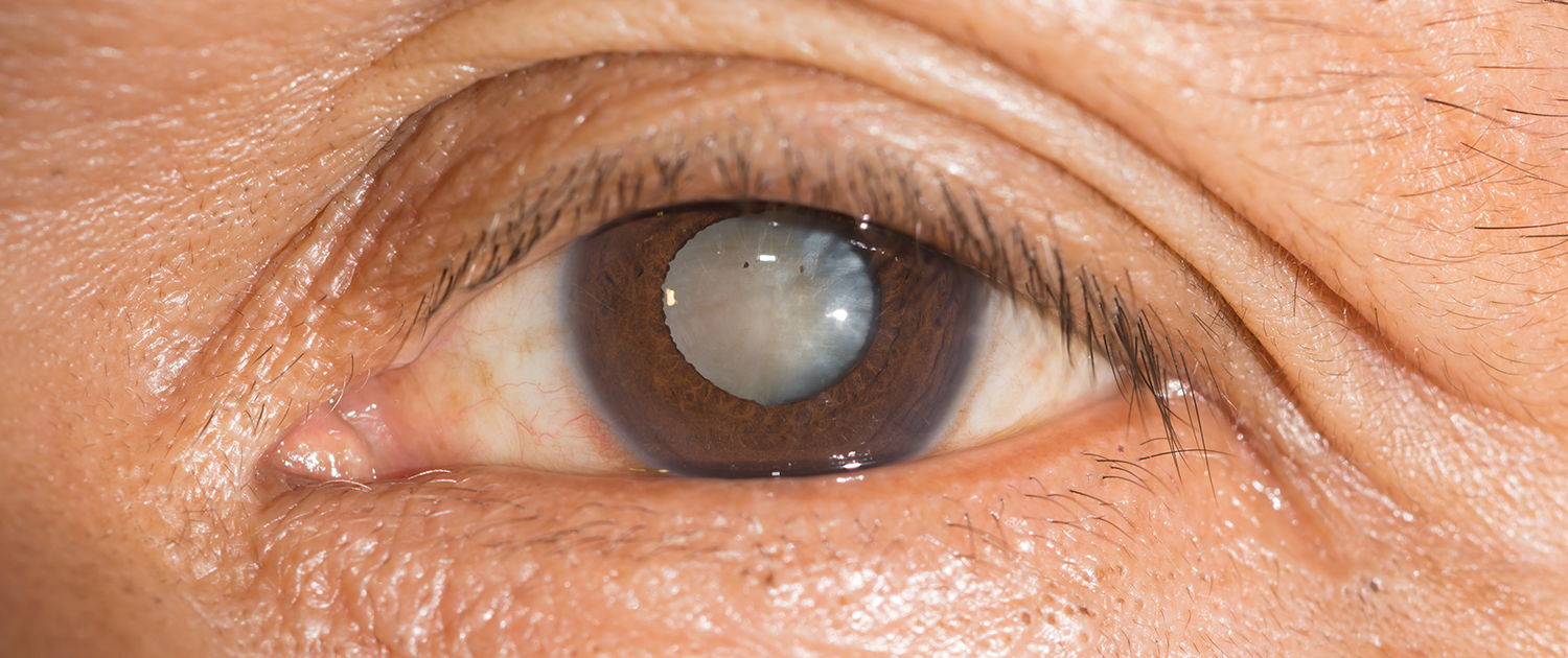 cataratta: occhio con pupilla schiarita