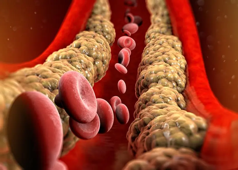 Colesterolo, l'immagine mostra un'arteria ostruita dal grasso in eccesso