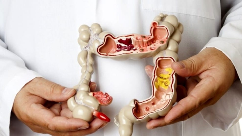 malattia di Crohn perianale