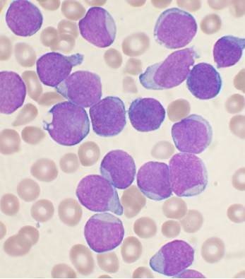 Leucemia: nuova total marrow irradiation