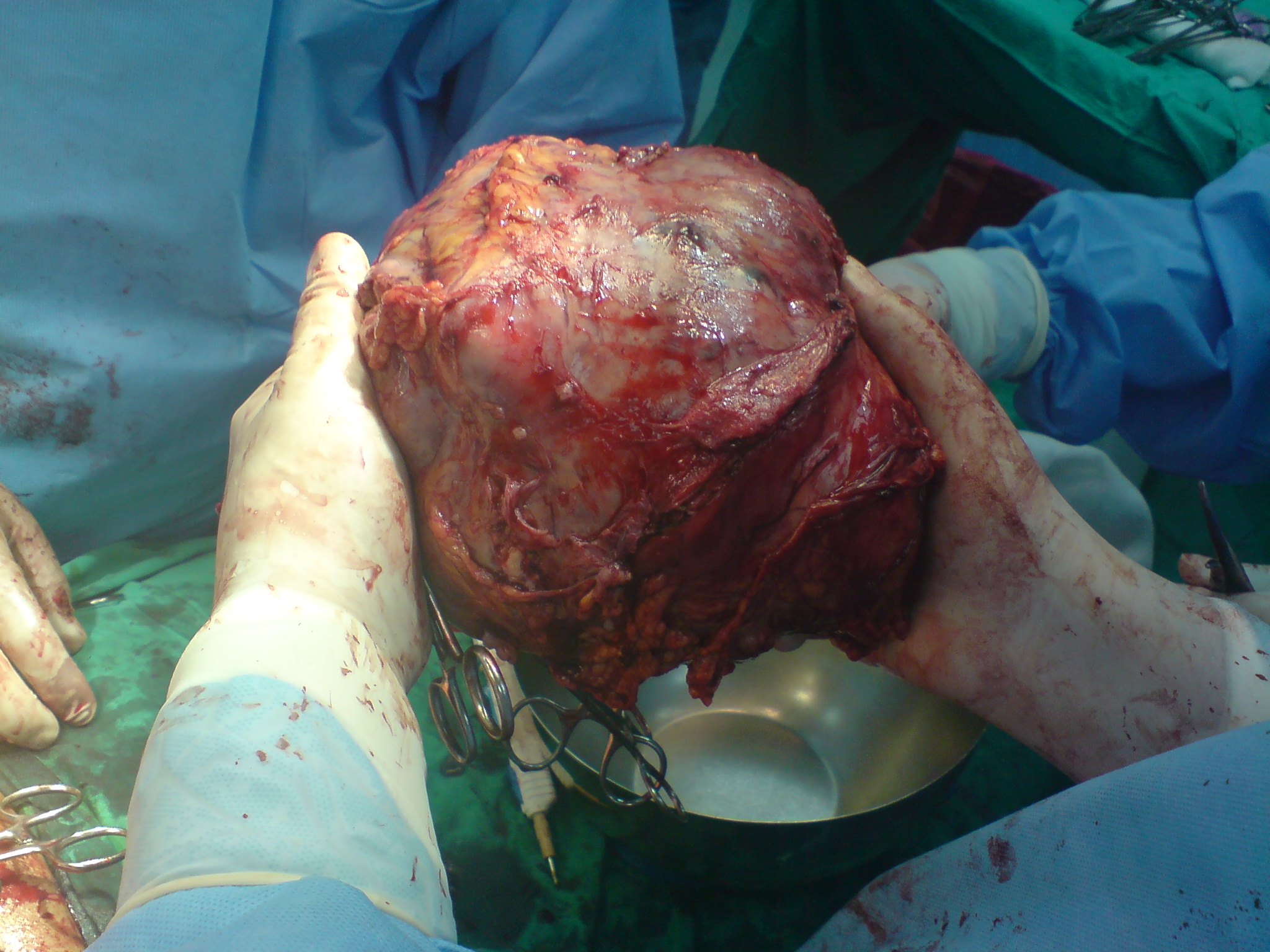 tumore del fegato