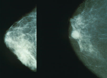 mammella con tumore